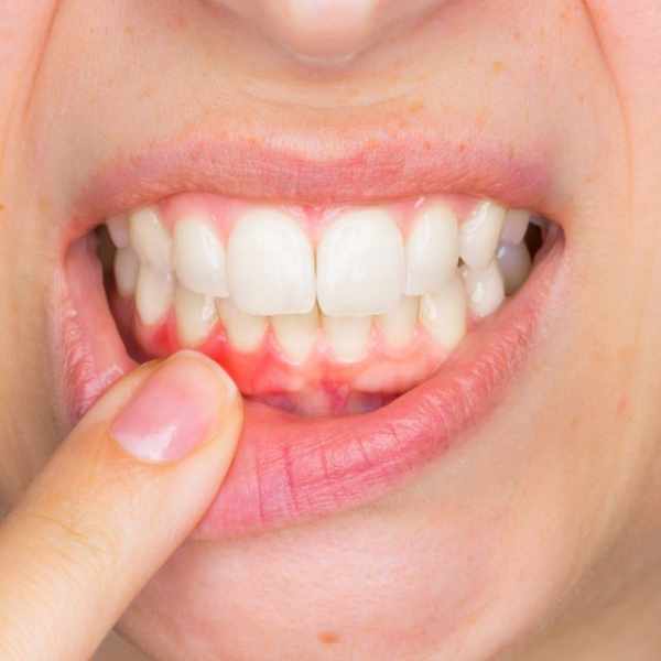 5 Penyebab Gigi Goyang pada Orang Dewasa